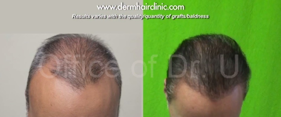 Facial Hair To Head Surgery with 6,000 grafts using UGraft Results