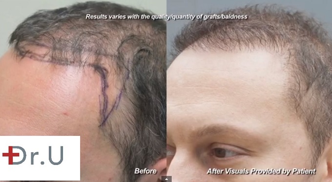 Close Up View of Temples| Before and After FUE Surgery