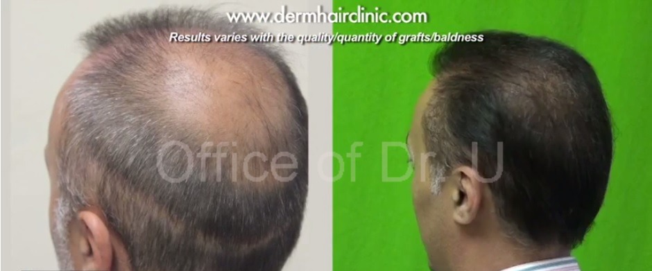 Crown and Strip Scar before and after Facial Hair To Head Surgery with 6,000 grafts