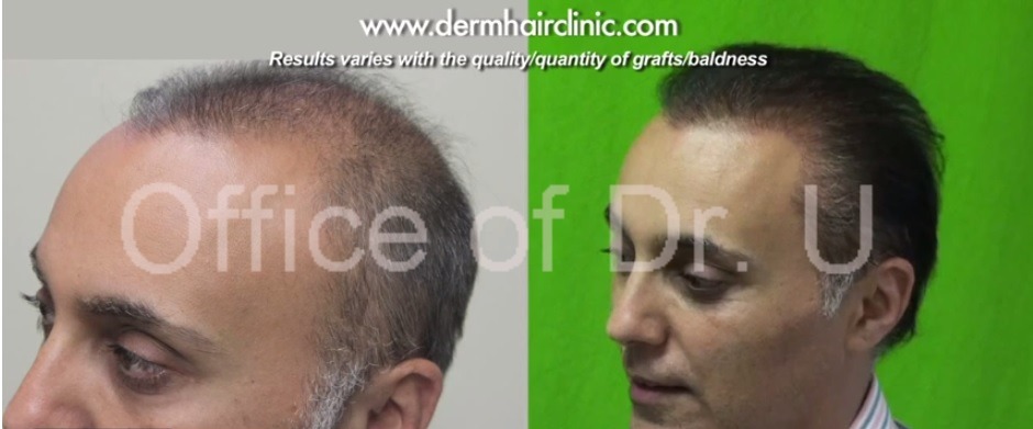 Temple Hair Restoration| Body Hair to Head Procedure-6000 Grafts Strip Scar Repair