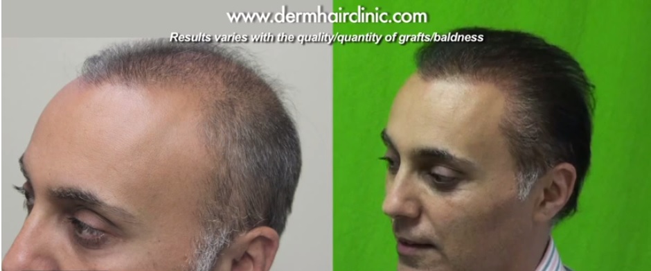 Beard and Head Hair|Transplant Surgery