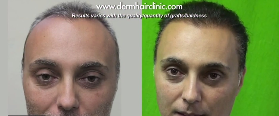 body hair transplant for more coverage
