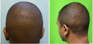 hair loss treatment African American