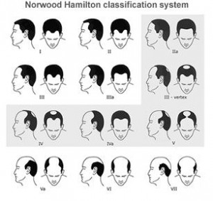 pattern baldness hair loss