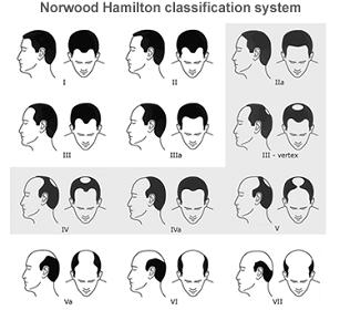 stages of male pattern baldness unlike DUPA. What is the role of body hair transplant in diffused alopecia