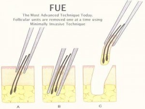 The process of a typical FUE hair transplant procedure