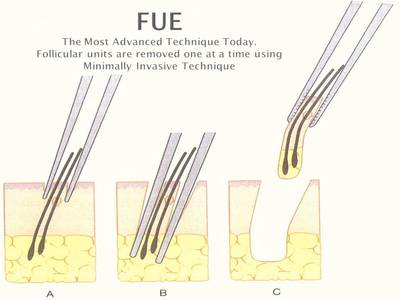 FUE hair transplant methods are done by removing individual groups of follicles using tiny punches
