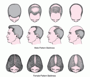 hair loss patterns in men and women