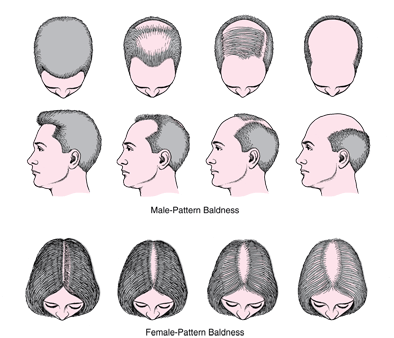 What causes people to lose hair