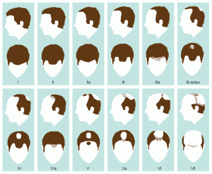 progression of male pattern baldness