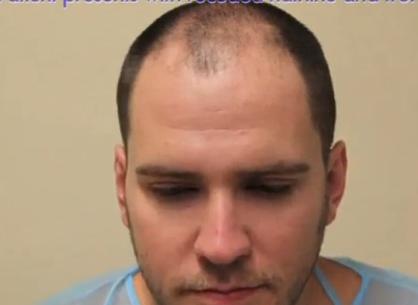 Patient Prior to His FUE Hairline Restoration Surgery