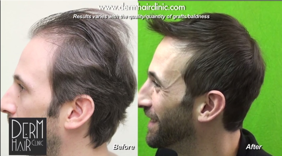 Choosing Hair Transplant Surgery