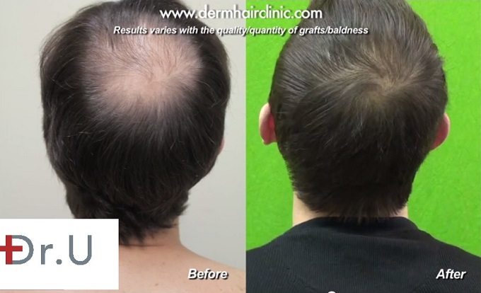 Restoring crown first, Before Hairline Transplantation - before and after Dr Umar Transplant