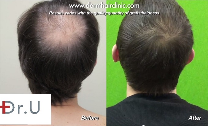 Celebrity Hair Transplant of Bernardo De Paulo