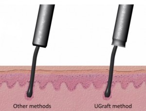 hair loss surgery and Follicular Unit Extraction