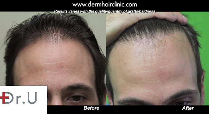 Celebrity Hair Transplant of Bernardo De Paulo: Patient's Hairline Edge| Natural Looking Results