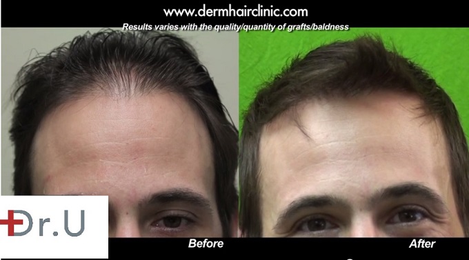 Patient's Transformation Due to Hairline hair transplantation 