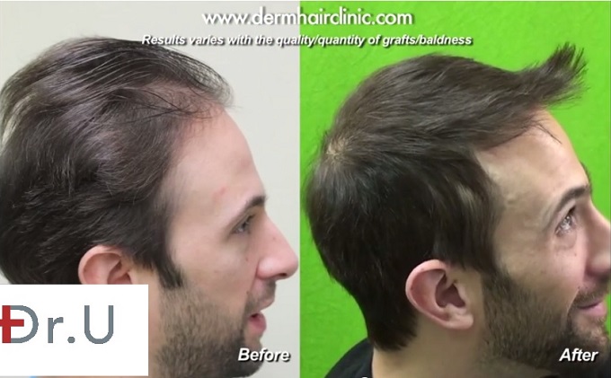 Profile View of Hairline and Temple Restoration| FUE Results