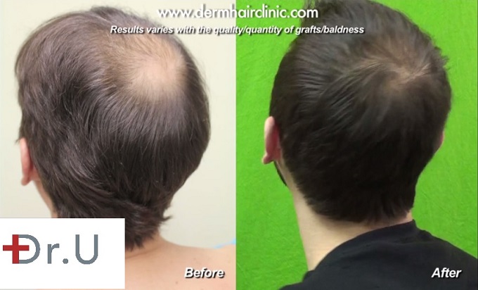 Crown Hair Restoration| FUE- Celebrity Hair Restoration