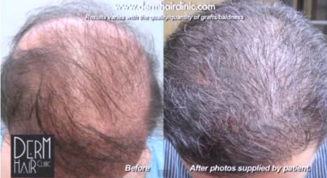 Before and after Advanced FUE surgery. Beard hair grafts were used to provide abundant coverage