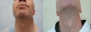 Beard hair FUE wound healing photos