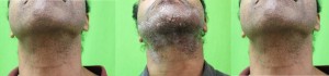 Beard hair follicular extraction wound healing results