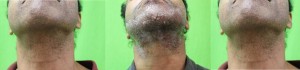 Beard hair follicular extraction wound healing results Beard hair follicular extraction wound healing results