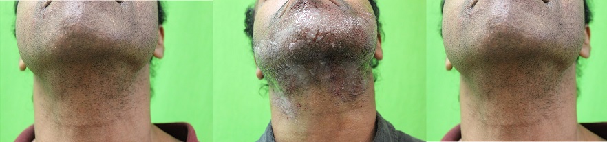 Body hair transplant wound healing results in an AFrican AMerican Body hair transplant wound healing results in an AFrican AMerican