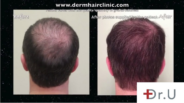Crown Hair Loss and Thinning| Restoration of Coverage