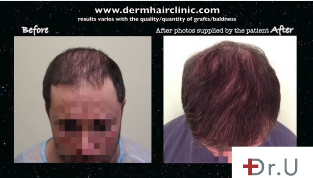 Hairline Recession| Before and After Hair Transplant Procedure