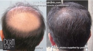 Acell Therapy Does NOT Improve Hair Surgery Growth, However UGraft Transplant Does