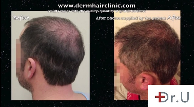 Side of Head and Vertex| New Coverage With BHT Surgery - 8000 Grafts