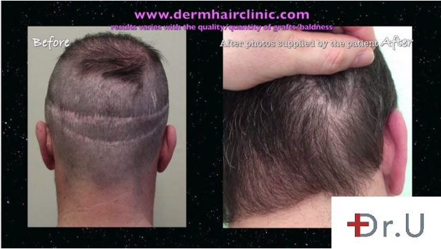 Repair of Deep Strip Scars| BHT - 8000 Grafts Repair of Deep Strip Scars| BHT - 8000 Grafts
