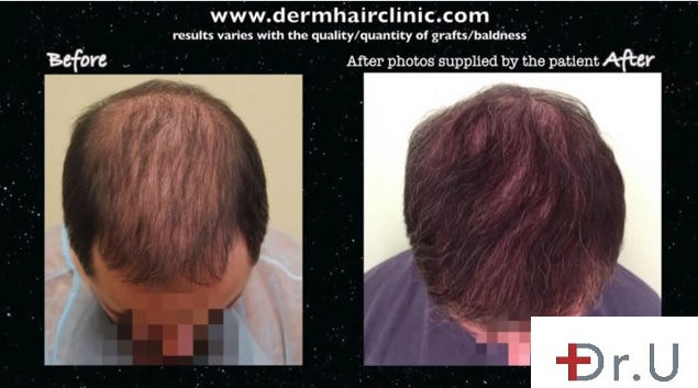 BHT Hair Surgery For Scar, Crown, Top and Hairline - 8000 UGraft Patient Photos