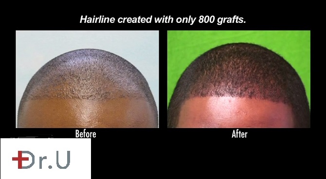 African American FUE hair restoration results