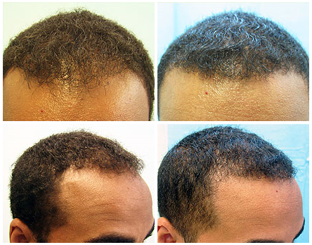 African American FUE hair restoration body hair Transplant results 