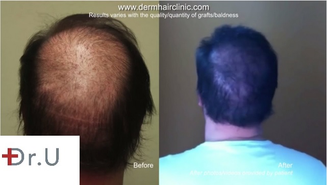 beard hair to head transplant 7000 grafts Crown Hair Restoration|