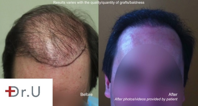 Beard Hair to head transplant 7000 grafts Hairline Results