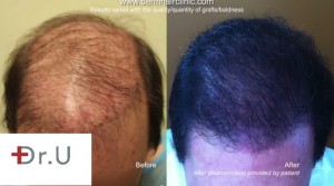 Successful Repair With Body Follicles