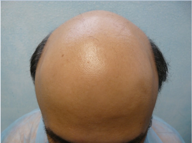 Hair Loss and research Hair Loss and research