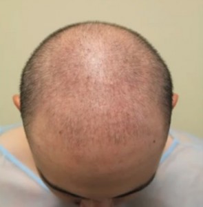hair loss patient
