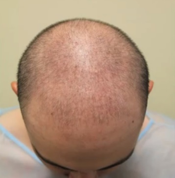 Patient With Genetic Hair Loss