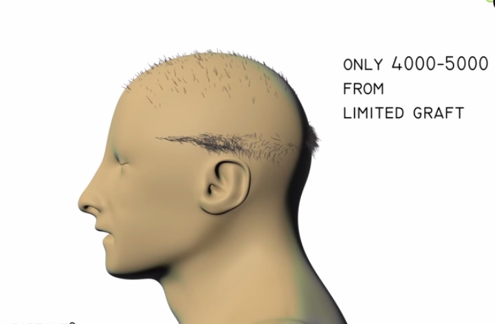 Advanced FUE severe baldness