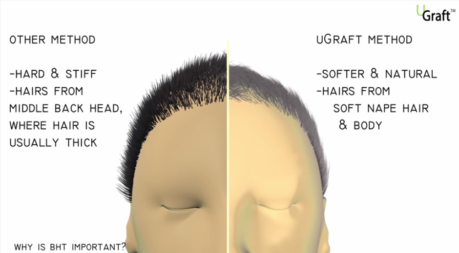 Advanced FUE for natural looking hair transplant results