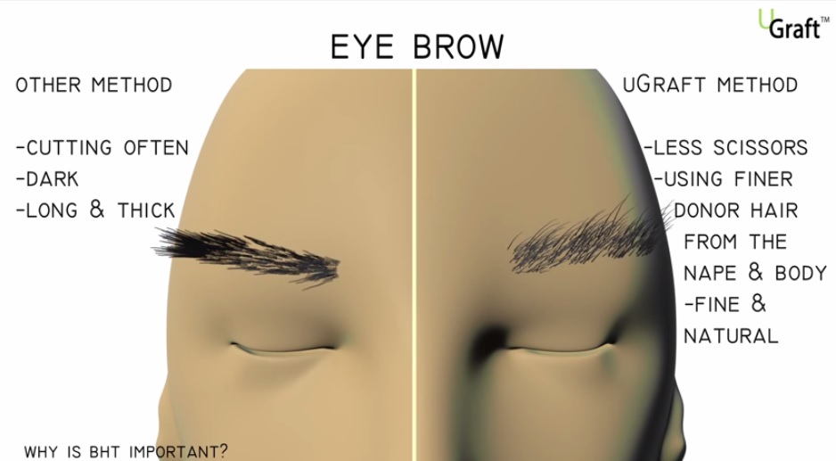 Advanced FUE for eyebrow restoration