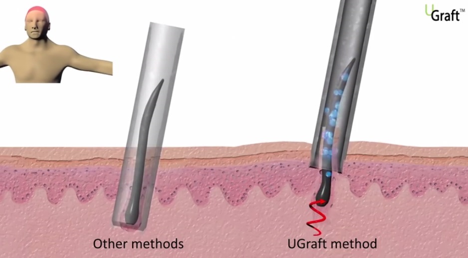 Advanced FUE uGraft mechanism