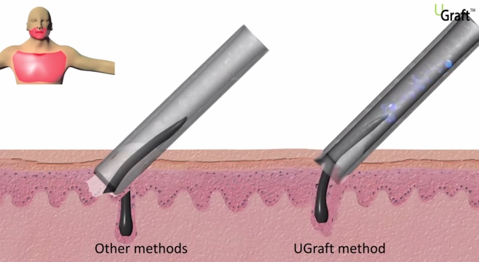 In the UGraft FUE Hair Transplant Video the unique attributes of the UPunch are illustrated