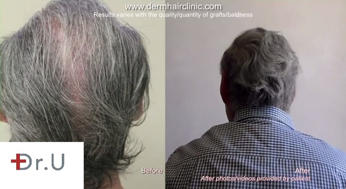 Dr U patient before and after UGraft dense packing hair transplantation