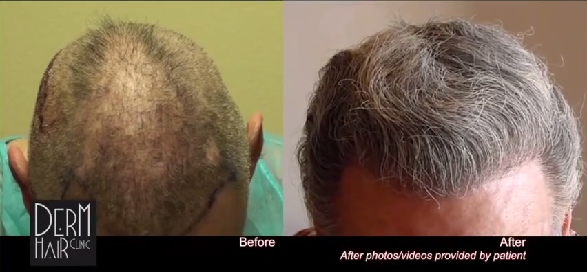 curly hair grafts - hair transplants