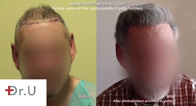 Hairline and Temple Restoration|Before and After Photos of Patient Body Hair Transplantation with 7300 Grafts|Hairline and Temple Restoration|Before and After Photos of Patient